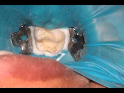how to treat abscess tooth