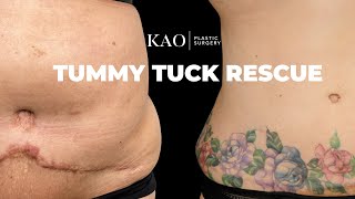 Tummy Tuck Rescue - Tummy Tuck With 360 Sculpt Liposuction - KAO Plastic Surgery - Graphic Content