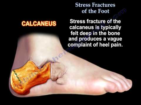 how to treat jones fracture