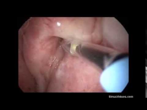 how to drain eustachian