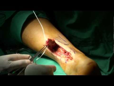 how to snap achilles tendon