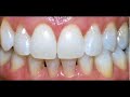lkr - smile