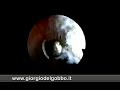 Impingement osseo Impingement osseo