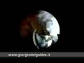 Impingement osseo