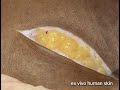 PEAK Surgical - PlasmaBlade Surgical Device & Tissue Dissection System for Bleeding Control