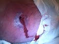 Abscess Pus or Puss coming out my poisonus infected leg