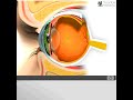 Anatomie de l'oeil 3D: Quantel Medical