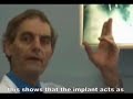 Metalosis Maligna - Captioned (E399.W Conference) Metalosis Maligna - Captioned (E399.W Conference)