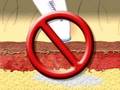 Cold Sore Prevention System - interceptCS