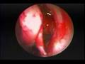 Endoscopic Treatment of Allergic  Fungal Maxillary Sinusitis
