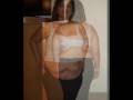 Lapband Pics Before and After 3 Months (Transforming)