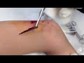 Guy has hugest splinter ever in his leg (wait for it...) - [0:46]
