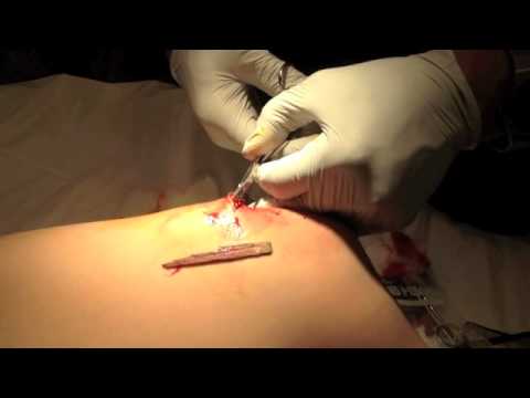 how to get a splinter out that is under the skin