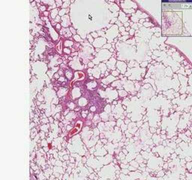 Histopathology Lung--Emphysema