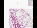 Histopathology Lung--Emphysema