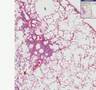 Histopathology Lung--Emphysema