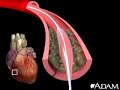 Coronary Angioloplasty