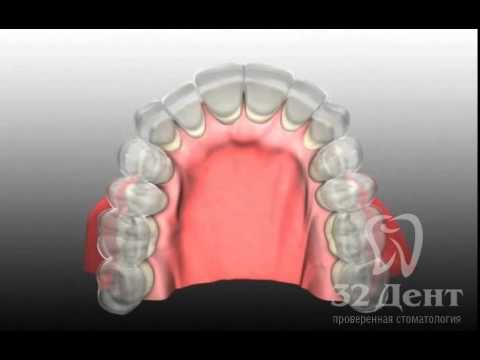 Ортодонтия. Исправление прикуса с помощью брекетов-каппы