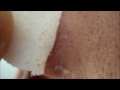 Blackhead removal close up! (using Biore pore strip)