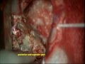 EPIDERMOID left temporal -parietal lobe-microsurgery-dr suresh dugani/ HUBLI/KARNATAK/INDIA