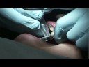 Hands-On Demonstration of SPEE Slenderizer System