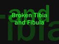 BROKEN TIBIA AND FIBULA