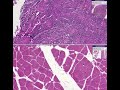 Histopathology Skeletal muscle, face--Alveolar rhabdomyosarc Histopathology Skeletal muscle, face--Alveolar rhabdomyosarc