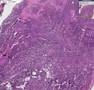 Histopathology Skeletal muscle, face--Alveolar rhabdomyosarc