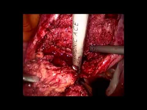 how to cure adenomyosis