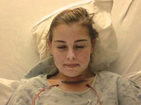 PEXY - This 18 year old female developed severe airway stenosis from prolonged intubation after a closed head injury from an MVA. I performed multiple efforts at wi...