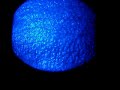 Extreme Keratoconus - RGP Ultracone Lens