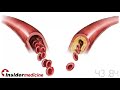 Insidermedicine in 60 - July 7, 2008  Cholesterol Nutritional Medicine