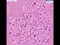Histopathology Brain--Astrocytoma