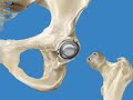 Birmingham Hip Resurfacing