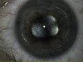 Travis's PRK, Right Eye Travis's PRK, Right Eye