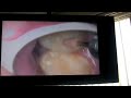 polishing fillings