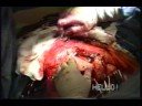 Neurocirugia