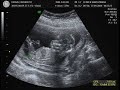 Bebe 14 semanas Nayita y Rodys Bebe 14 semanas Nayita y Rodys