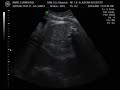 3. trimesterde ultrasonografi