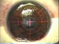 My Lasik Eye Surgery My Lasik Eye Surgery