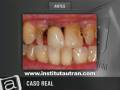 Estética dental: casos extremos (problema y solución)