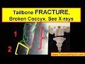 X-rays showing COCCYX FRACTURE (broken tailbone)