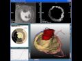 Steffen Oeltze: Integrated visualization of myocardial perfusion and the hearts anatomy.