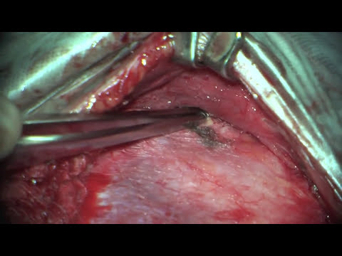 Cirurgia de Tumor Cisto Dermóide - teratoma - no crânio. Skull Dermoid Cyst Surgery