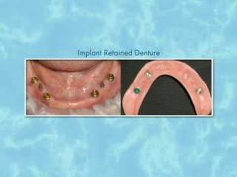 Implant Dentistry