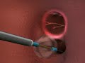 Crioablación en fibrilación auricular Crioablación en fibrilación auricular