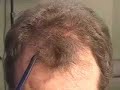Hair transplant dallas:  elapsed time journey