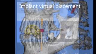 Computer Guided Implant Surgery