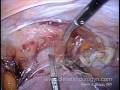 Uterus Excision Using SILS/LESS Technique Uterus Excision Using SILS/LESS Technique