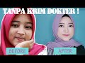 MELAWAN JERAWAT TANPA KRIM DOKTER | MY SKINCARE RO
